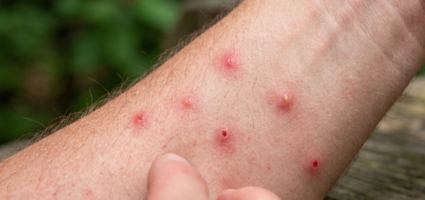 no-see-um bites on wrist