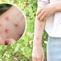 bug bite comparison