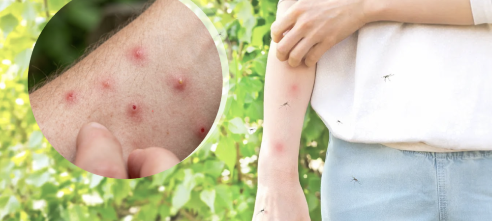 bug bite comparison