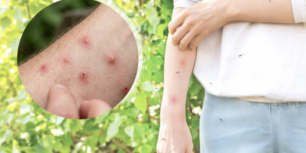 bug bite comparison